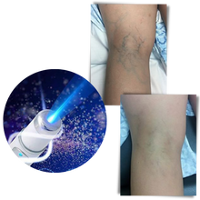 Carica l&#39;immagine nel visualizzatore di Gallery, Penna per la terapia della pelle a luce blu - Ozerty
