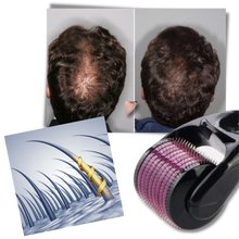 Carica l&#39;immagine nel visualizzatore di Gallery, Rullo Derma per la crescita di capelli e barba - Ozerty
