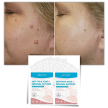 Carica l&#39;immagine nel visualizzatore di Gallery, Cerotto per il trattamento di rimozione delle escrescenze della pelle - Ozerty
